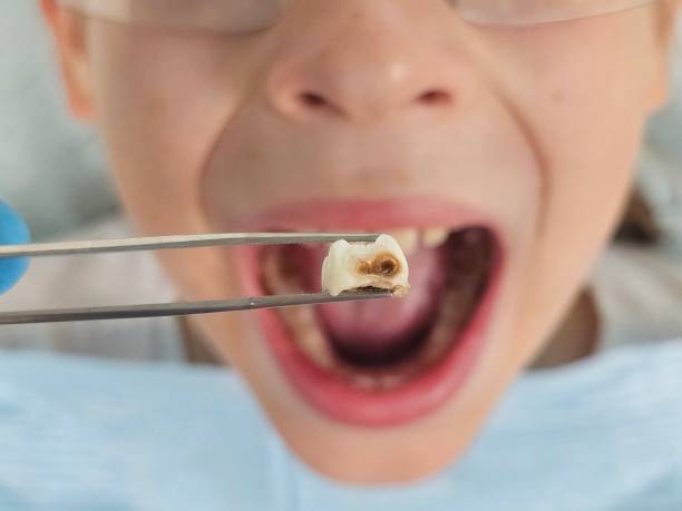 Best Emergency Broken Tooth Repair in Joplin, MO